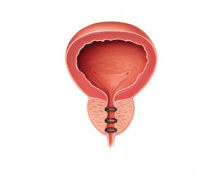 diagram of an implant in an enlarged prostate